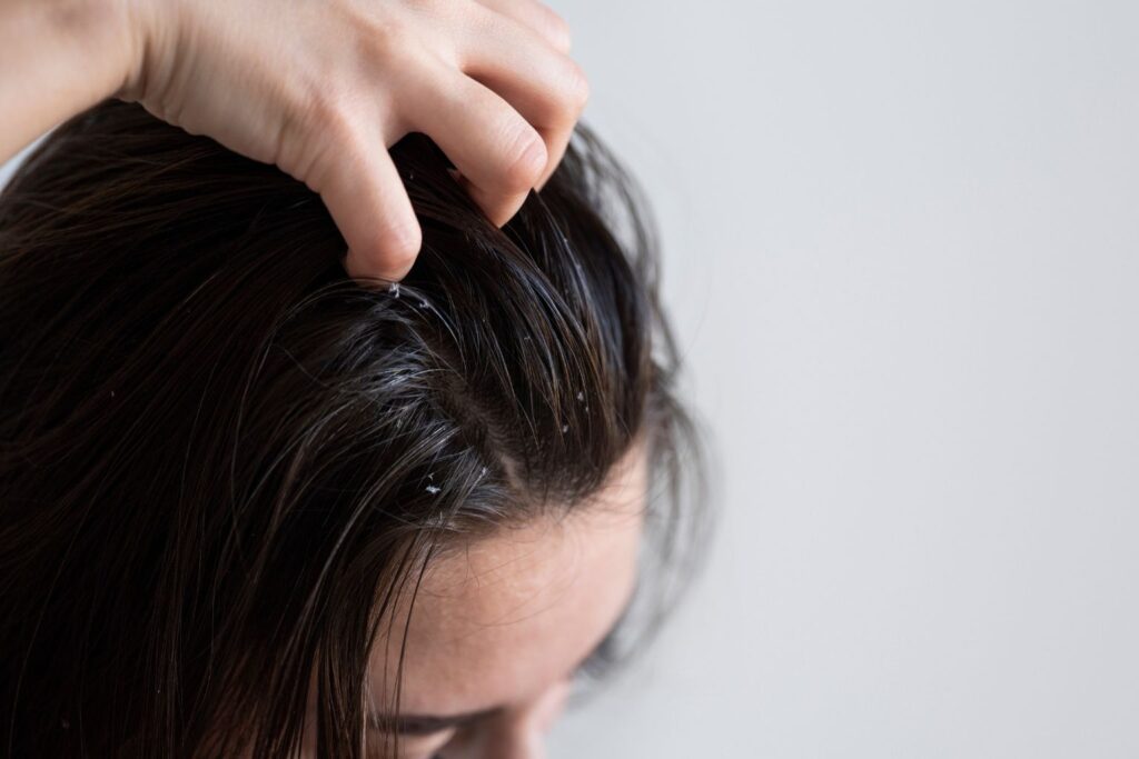 How To Remove Dandruff From Hair Step By Step Guide
